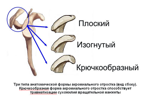 Три типа анатомической формы акромиального отростка (вид сбоку)