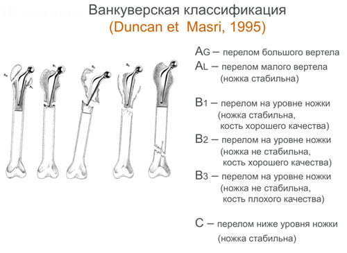 Ванкуверская классификация Ванкуверская классификация