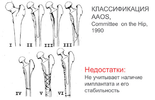 КЛАССИФИКАЦИЯ AAOS КЛАССИФИКАЦИЯ AAOS